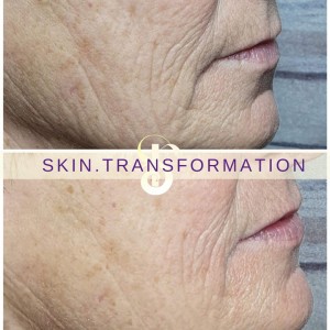 HIFU - Non chirurgische Facelift